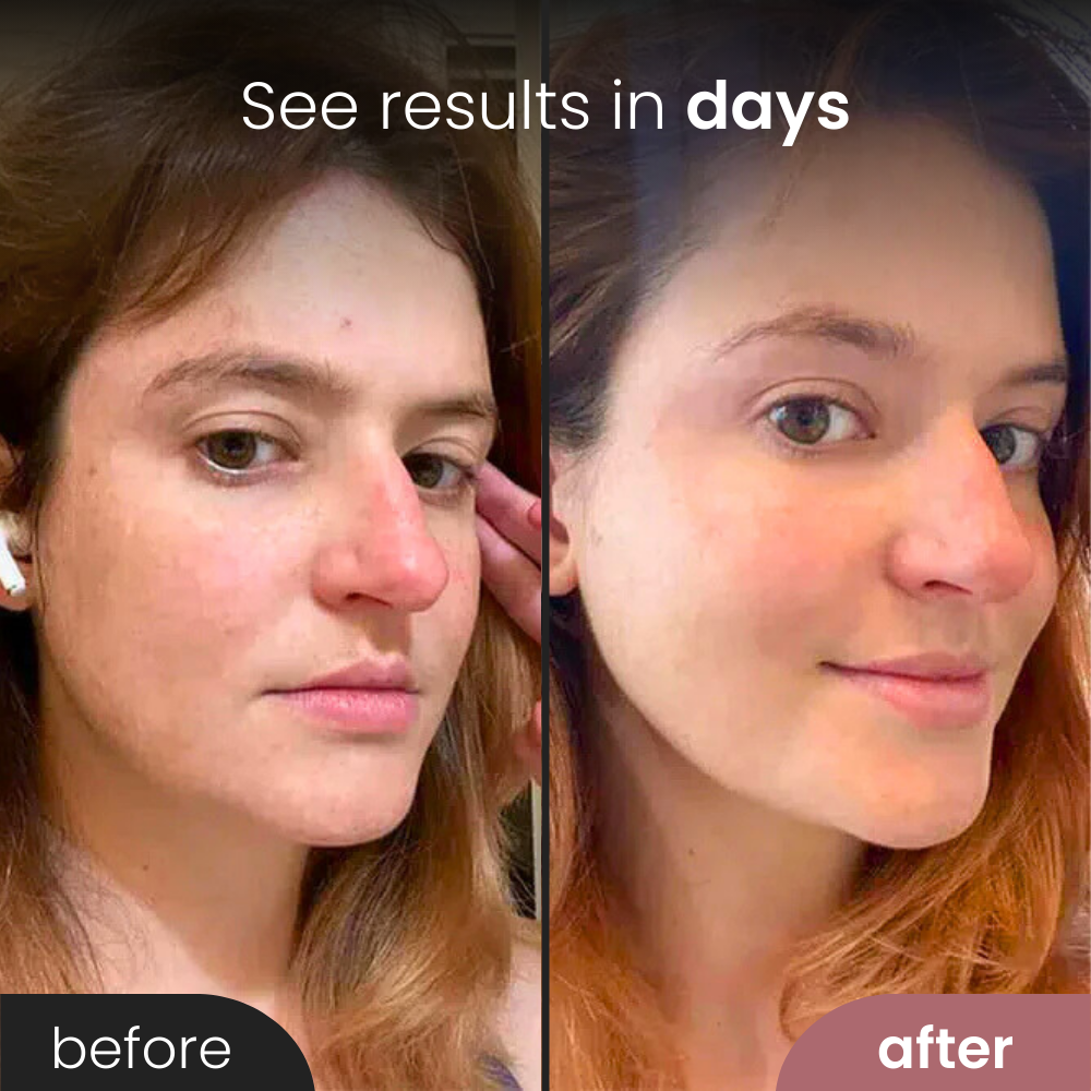 Renew™ Light Therapy Wand